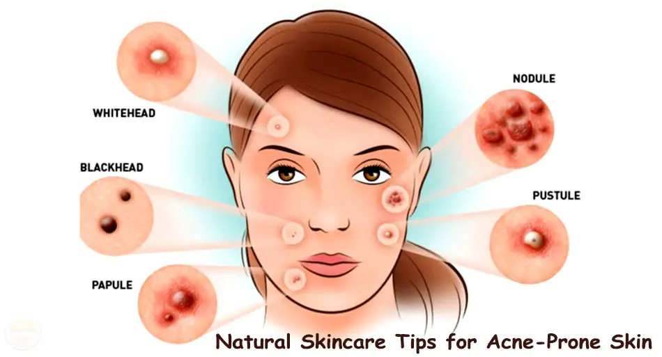 natural skincare tips for acne prone skin